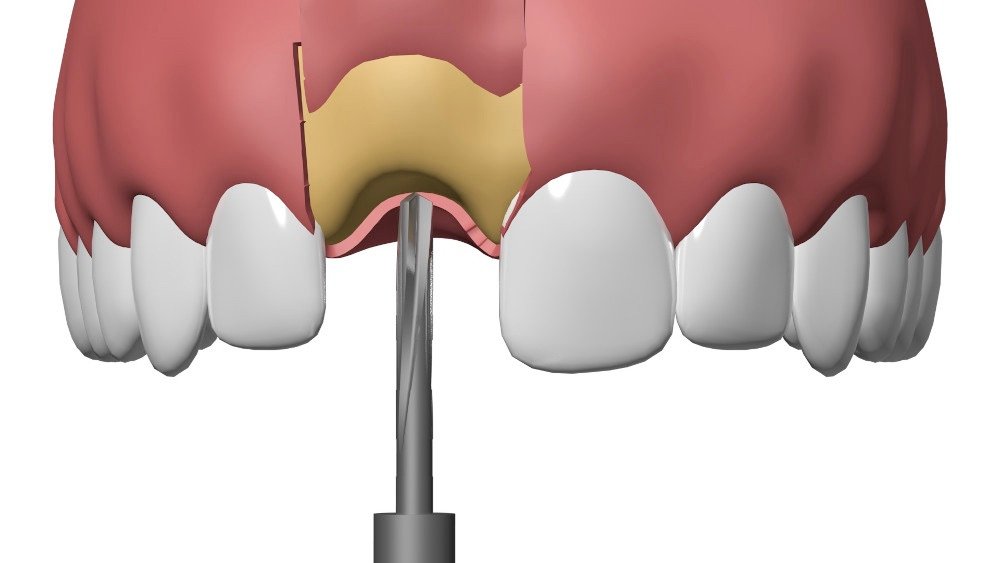 Implant dentaire Nimes